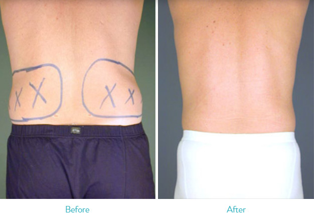 Flank Power Assisted Liposuction Machine For Fat Reduction / Body Shaping