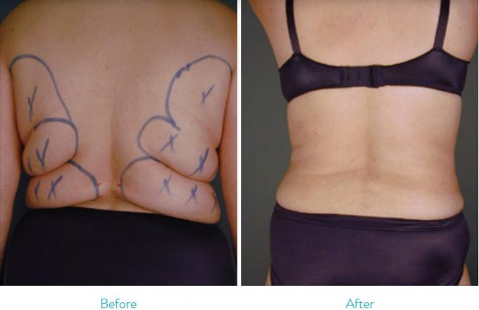 Flank Power Assisted Liposuction Machine For Fat Reduction / Body Shaping
