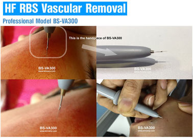 High Frequency Vascular / Spider Vein Removal Machine , Laser Varicose Vein Treatment