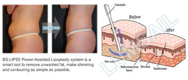 300W Surgical Liposuction Machine for Upper / Lower Back Liposuction