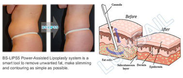 Liposuction Cavitation Slimming Machine Power Assisted
