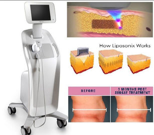 High Intensity Focused Ultrasound Liposonix Slimming Mchine , Ultrasound Face Lift Machine