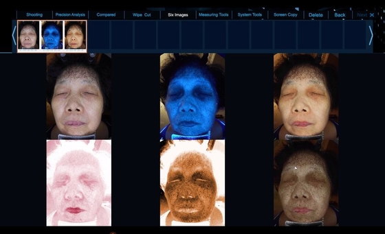 LUMSAIL 20 Mega Pixels Skin Analysis Machine / Skin Moisture Analyzer