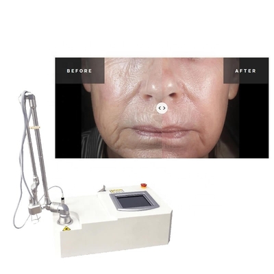 Portable 15w Co2 Fractional  Acne Surgical Scar Laser Machine