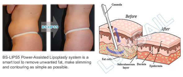 Liposuction Cavitation Slimming Machine Power Assisted