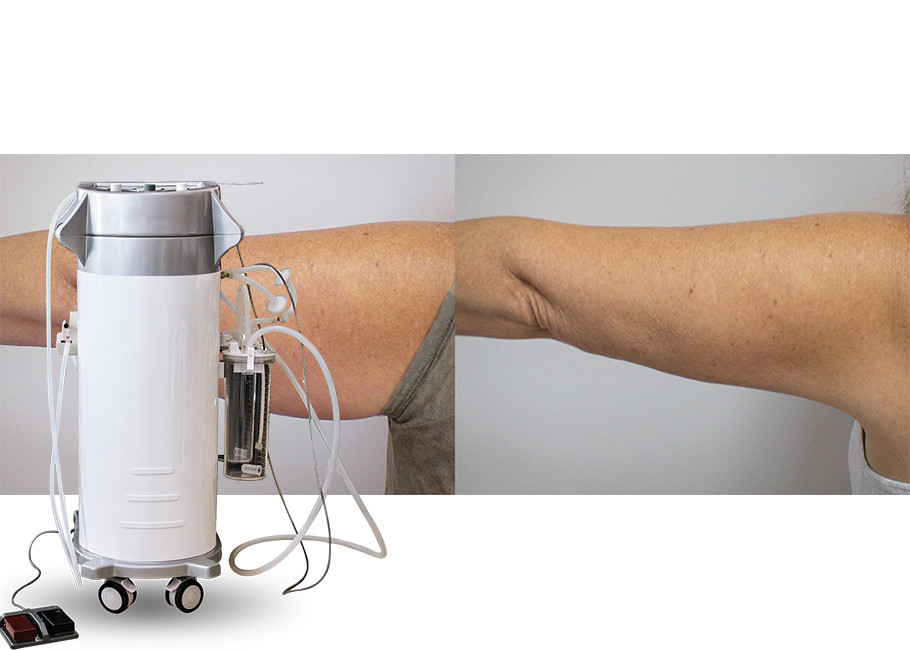 Power Assisted Surgical Vacuum Liposuction Cavitation Machine For Thighs / Arms / Back Treatment