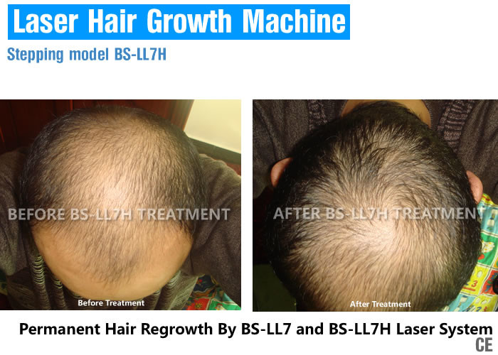 Vertical Low Light Laser Therapy For Hair Loss , Laser Treatment For Baldness